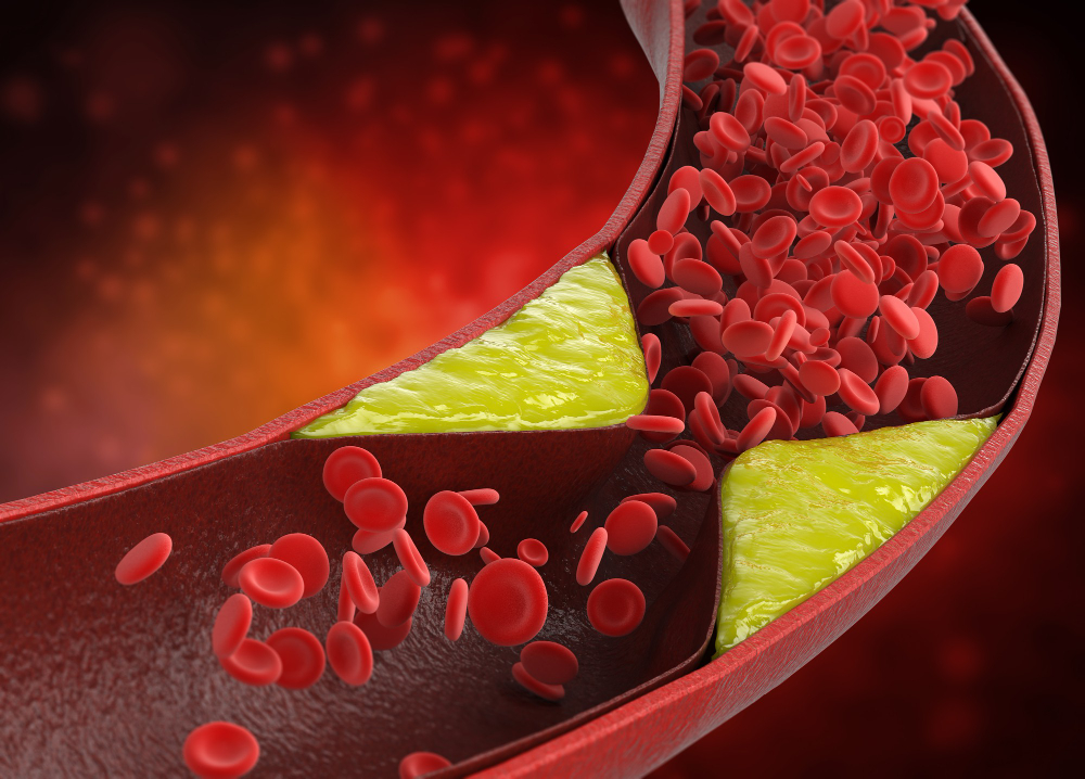 Read more about the article Cholesterol and Heart Disease: Understanding the Connection and How to Maintain a Healthy Heart